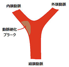 頚動脈超音波検査