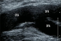 下肢動脈エコー