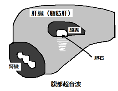 腹部エコー