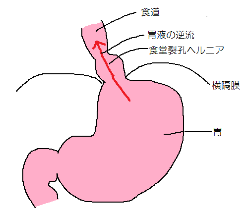 逆流性食道炎