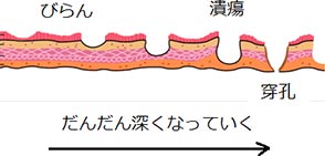 胃・十二指腸潰瘍