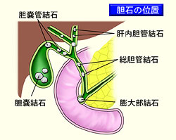 胆石の位置
