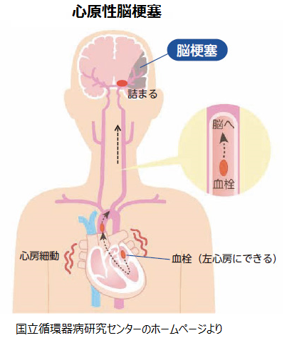 心原性脳梗塞