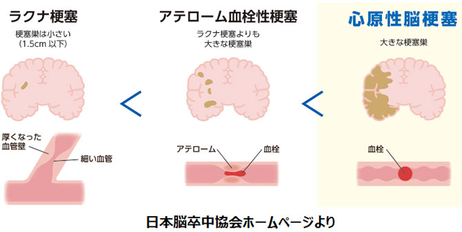 脳梗塞