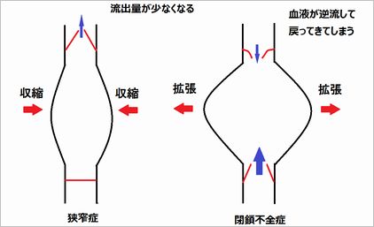 図３．狭窄症と閉鎖不全症