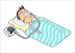 持続陽圧呼吸療法（CPAP）