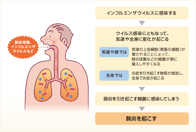 インフルエンザによって細菌性肺炎が起こります